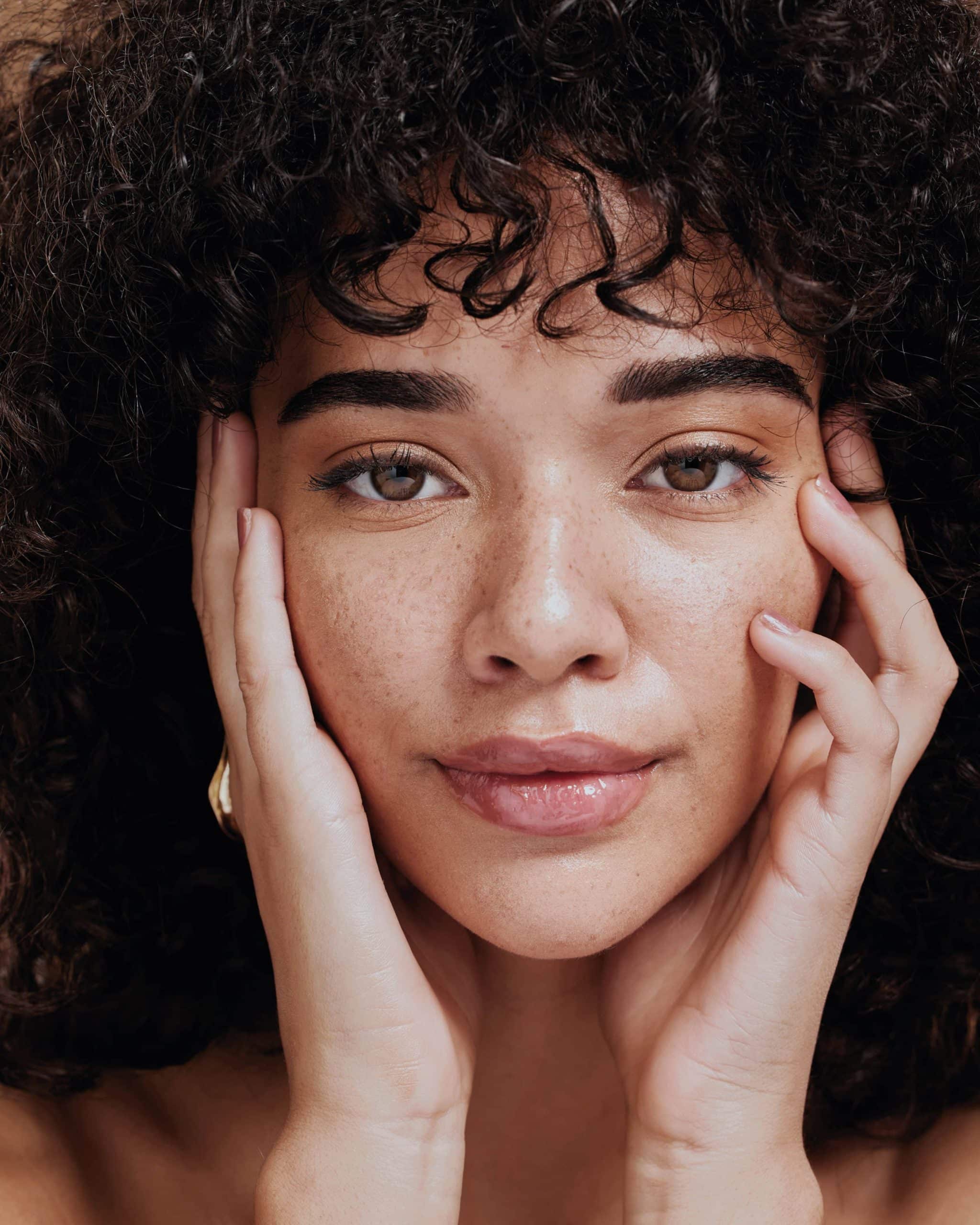 Frontaal portret van dezelfde vrouw; ze ondersteunt haar gezicht met beide handen waardoor de pigmentvlekken op wangen en neus goed zichtbaar zijn.