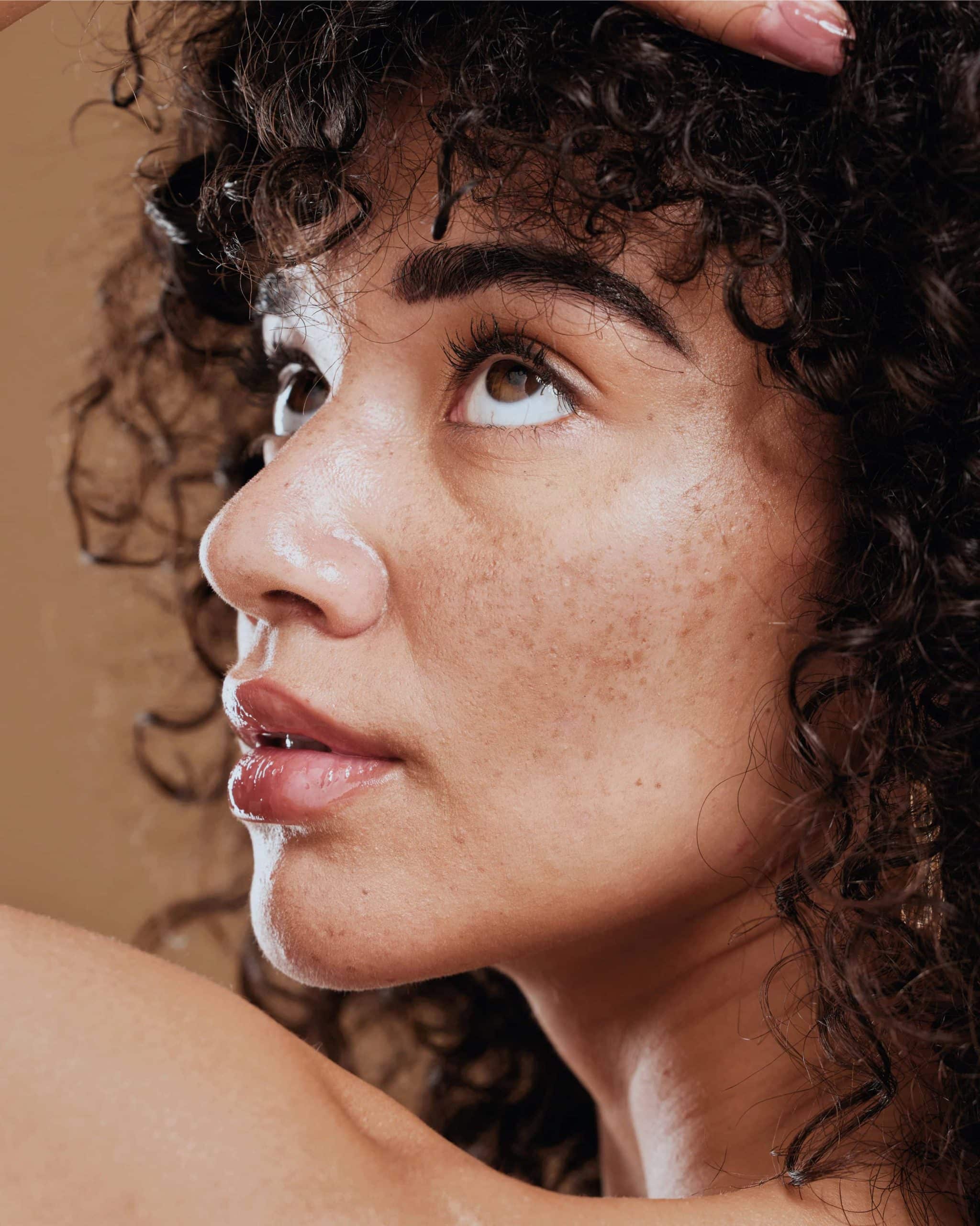 Close-up zijaanzicht van een jonge vrouw met krullend haar; haar wang toont lichte pigmentvlekken en sproetjes die typerend zijn voor melasma.