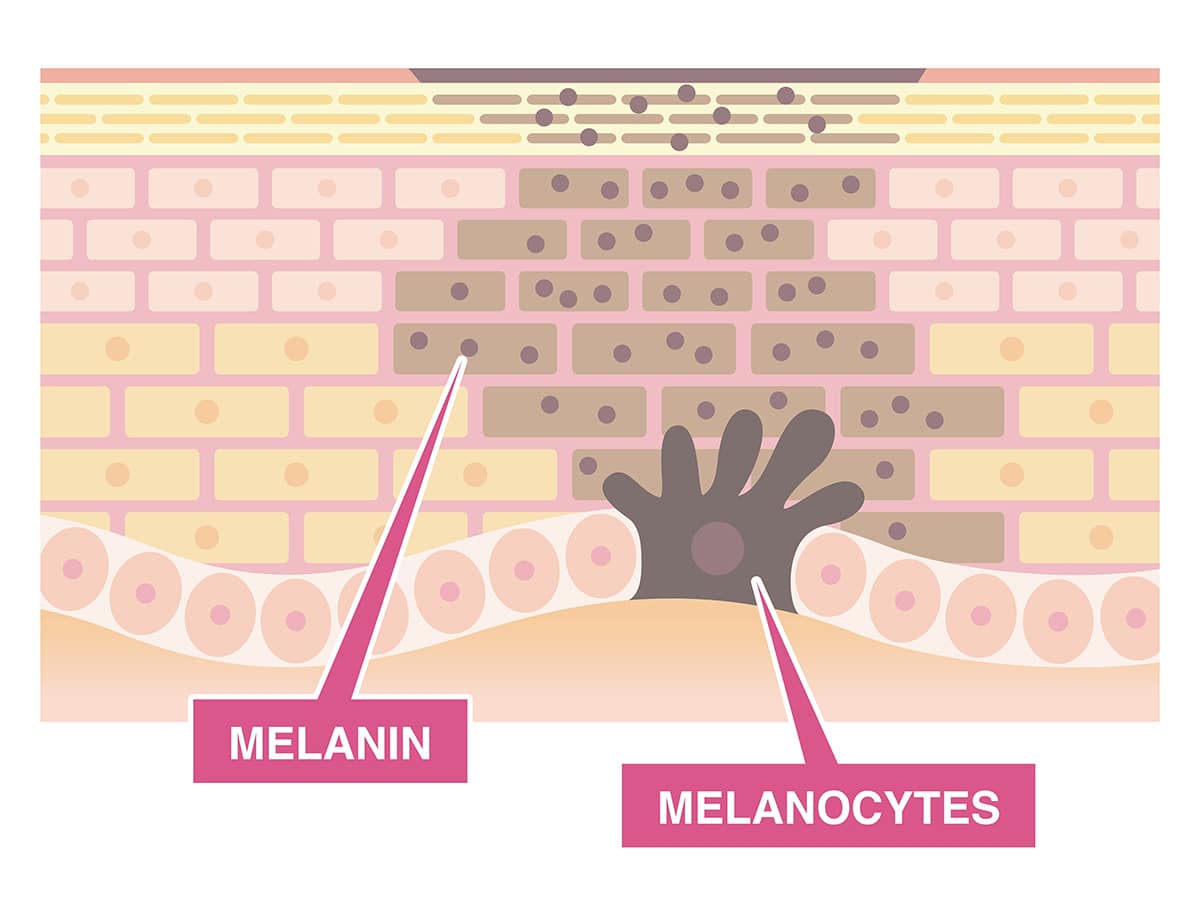 Overzicht van pigmentproblemen zoals melasma, ouderdomsvlekken en PIH op de huid