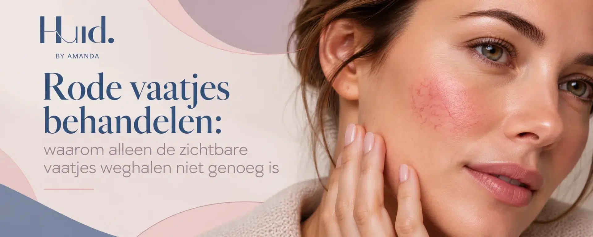 Rode vaatjes behandelen – blog Huid. by Amanda